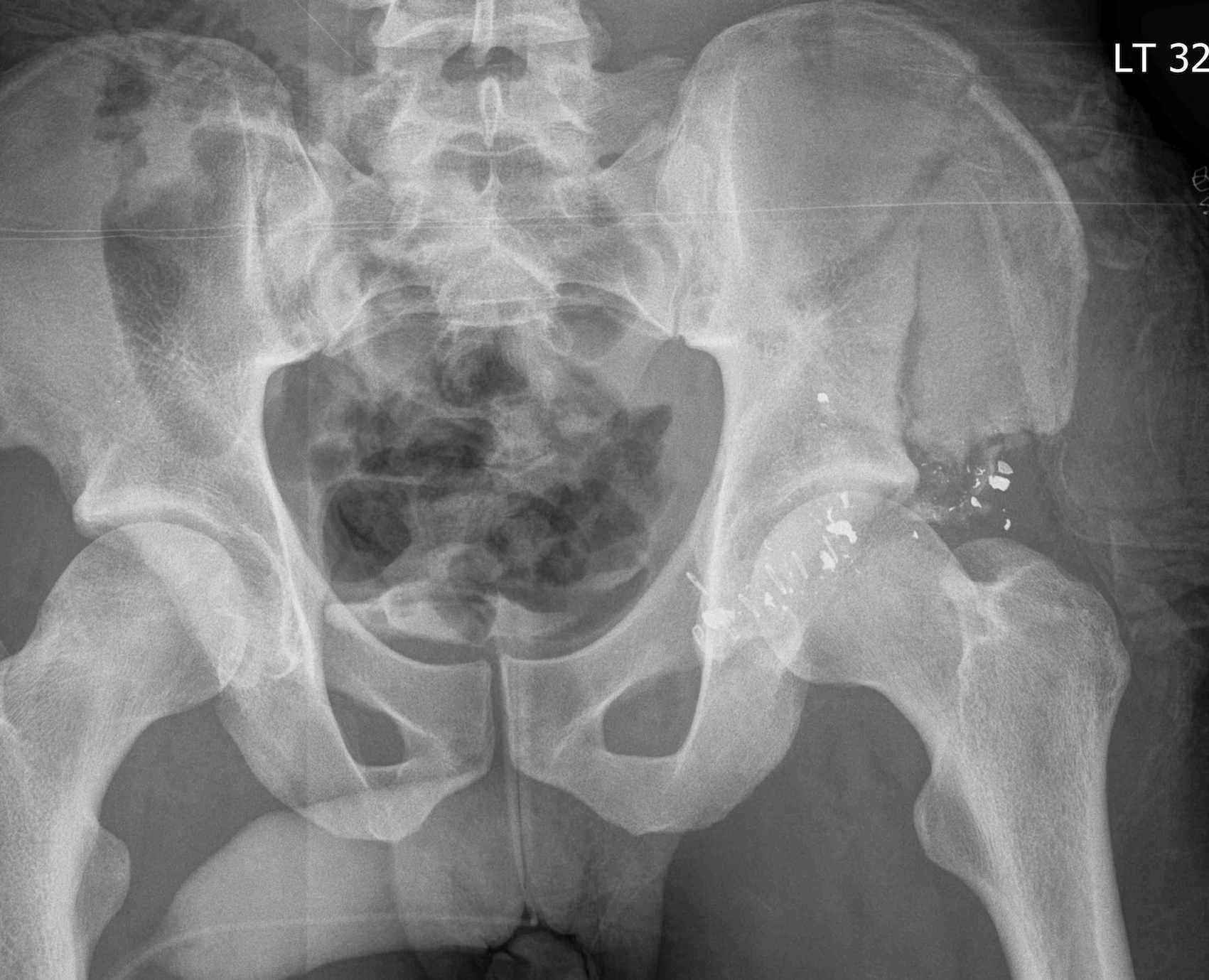 Gunshot Wound Compound Pelvic Fracture